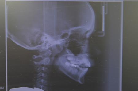 ORTODONTKA ZA OTROKE NA NAPOTNICO TUDI V BOVCU 4